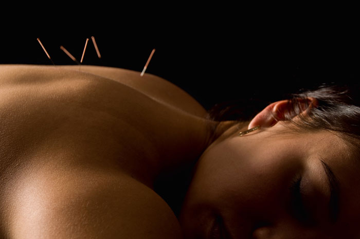 Acupuncture